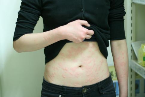 嚴重風疹塊易造成皮膚劇烈搔癢，讓人苦不堪言。圖非事件當事人。（圖片提供／台中慈濟醫院）