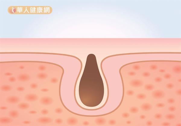 粉刺的形成，主要是由皮脂腺分泌的油脂與人體老廢角質堆積於毛囊所致。