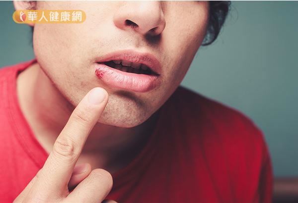 唇皰疹的傳染途徑為經由飛沫，或接觸帶有單純皰疹病毒的病人分泌物而傳染。