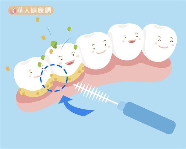 牙間刷與牙線的功用其實大不相同！有更多觸角（纖維）的牙間刷，主要作用在於協助清除牙齒縫與牙齦間不易清潔到「三角地帶」。