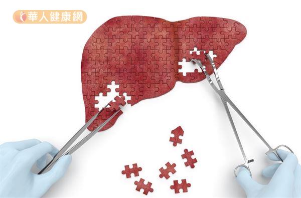 許多人認為C肝只會造成肝臟損傷，但國內外研究發現至少還可能引發10種肝外病變。