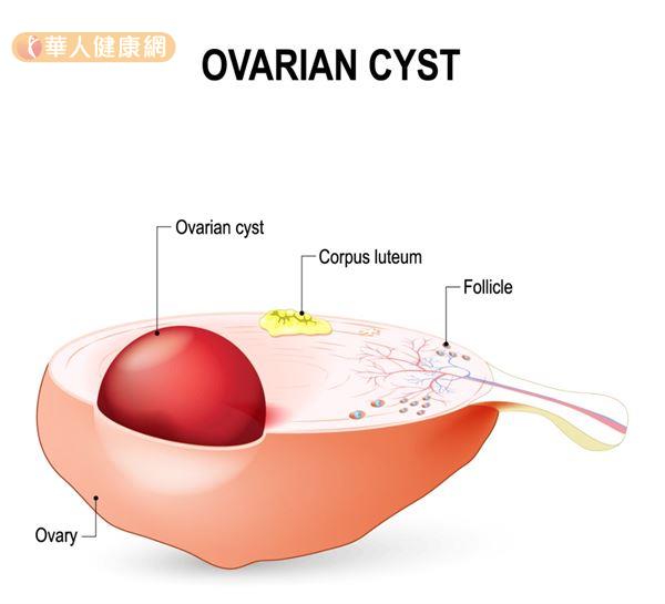 濾泡釋放出卵子後，轉變成黃體，若沒有萎縮並持續變大，則會形成黃體囊腫。