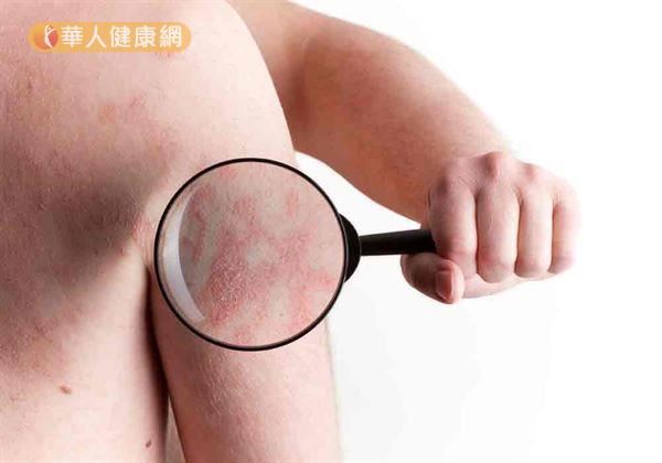 乾癬是一種慢性且反覆發作的皮膚病,與一般認知的「癬」有很大不同。