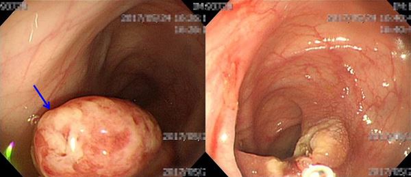 左圖顯示在大腸內視鏡影像下，發現病童大腸中段橫結腸處有1個大小約0.8公分的息肉。右圖為給予經內視鏡息肉切除術後，病灶已切除。（圖片提供／新竹馬偕醫院）