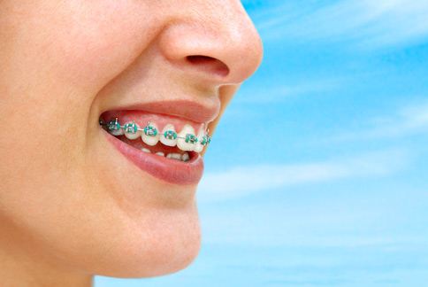 許多人誤以為忍耐2年「大鋼牙」的牙套生活，就能永久擺脫齒列紊亂的困擾。