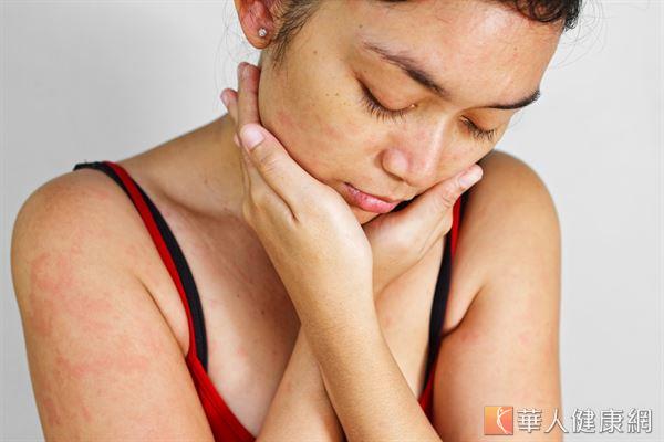 濕疹是一種常見的過敏性皮膚病，好發於人體各部位，不論頭頸部、四肢及臀部都可能看見它的蹤影。