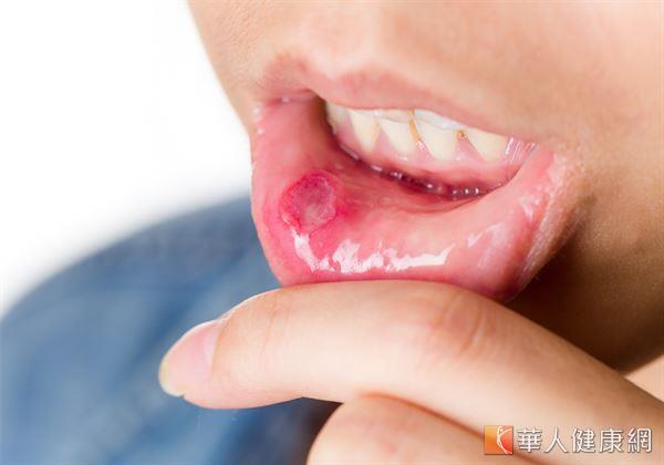 反覆出現嘴破、口腔潰瘍症狀，且發生頻率不但越來越高、持續時間越來越久，恐是貝歇氏症惹禍。