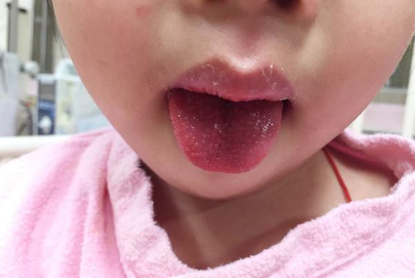 草莓舌。（圖片提供／衛福部豐原醫院）
