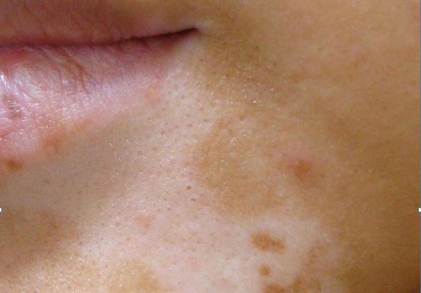 一名少女因唇部白斑症發作，給人口吐白沫的錯覺。（圖片提供／光田醫院）