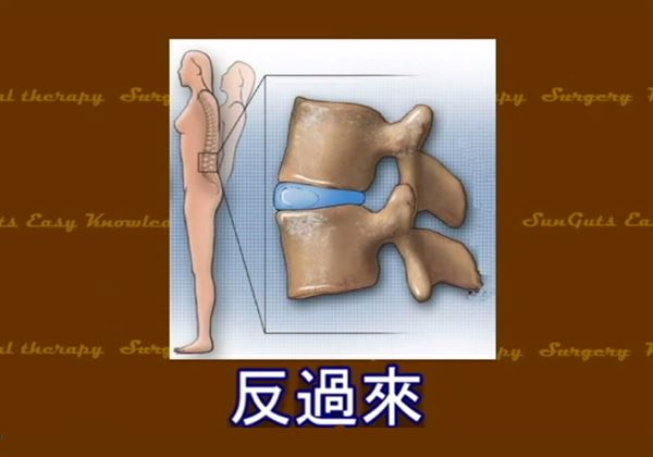 想要改善因椎間盤突出引起的腰間痠痛問題，必須適度藉由往後彎的動作，使後側的椎間孔壓力增加，才能真正達到讓椎間盤歸位的效果。（圖片／擷取自Sunguts youtube影片）