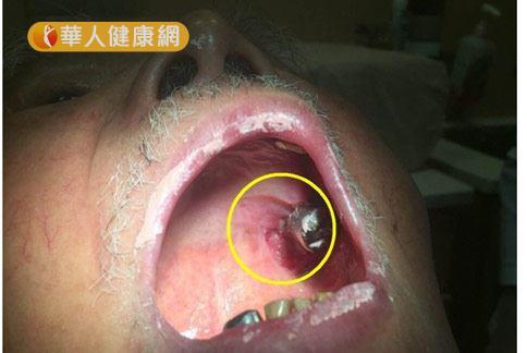 蘇姓老翁口腔左側上顎區內有1個大約3公分的潰瘍，證實罹患口腔癌第2期。（圖片提供／台北慈濟醫院）