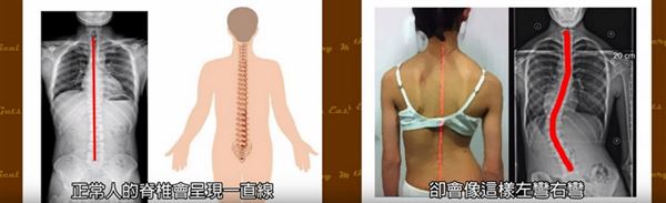 正常人的脊椎會呈現一直線，但若有脊椎側彎的人，脊椎會像這樣左彎右彎。（圖片／擷取自Sunguts youtube影片）