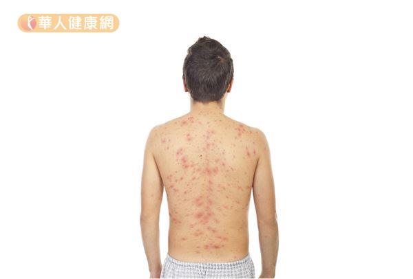所謂的帶狀皰疹在台灣又被稱之為「皮蛇」、「蛇纏腰」，是一種由水痘帶狀皰疹病毒（VZV）所引發的病毒性疾病。