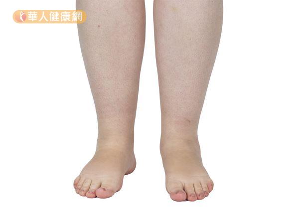 上熱下寒體質的人，下半身血液循環不佳，容易形成胖胖的蘿蔔腿。
