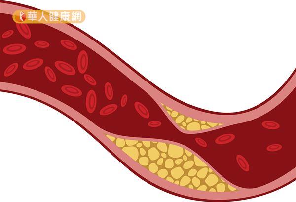 若血膽固醇過高，容易堆積在血管壁內層，引起慢性發炎並形成斑塊，使血管管徑變小、甚至阻塞。