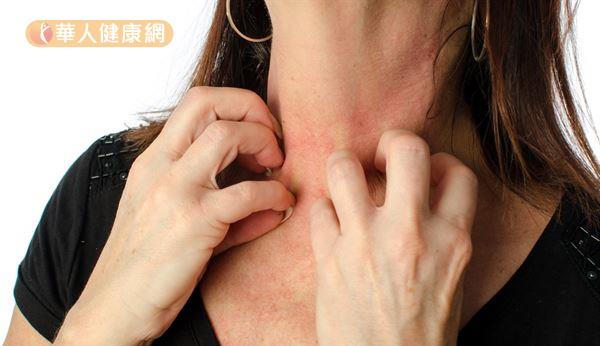 異位性皮膚炎患者的皮膚屏障功能受損，容易受低溫刺激而復發。