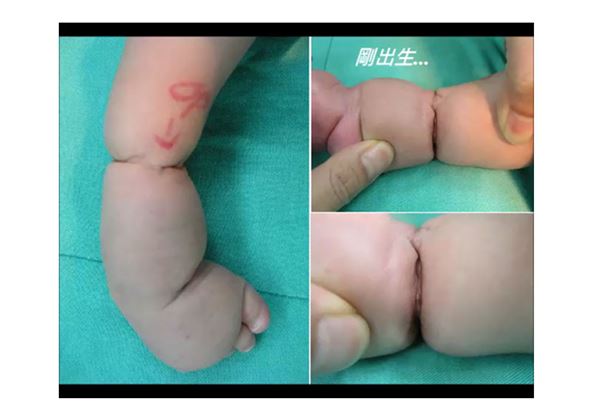 「米其林寶寶」發生原因是胎兒在子宮內發育時受到羊膜游絲纏繞，在手腳肢體上形成環狀皺褶。（圖片提供／臺北榮總醫院）