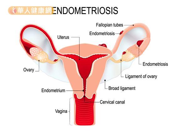 內膜組織長在卵巢會形成俗稱的「巧克力囊腫」；而長在子宮肌層的則是稱為「子宮肌腺症」。
