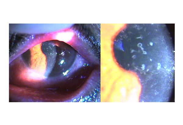 眼睛不慎接觸污水，有可能導致蟲蟲大軍入侵眼睛，罹患微孢子蟲角膜炎。（圖片提供／臺北榮總醫院）