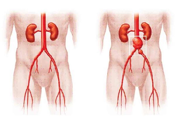 台北市立聯合醫院中興院區心臟血管外科劉亮廷主任表示，主動脈是人體最大的動脈，在腹腔的部分稱為腹主動脈，正常直徑約為2公分。一旦其超過正常大小的1.5倍以上，稱為腹主動脈瘤。（圖片／劉亮廷主任提供）
